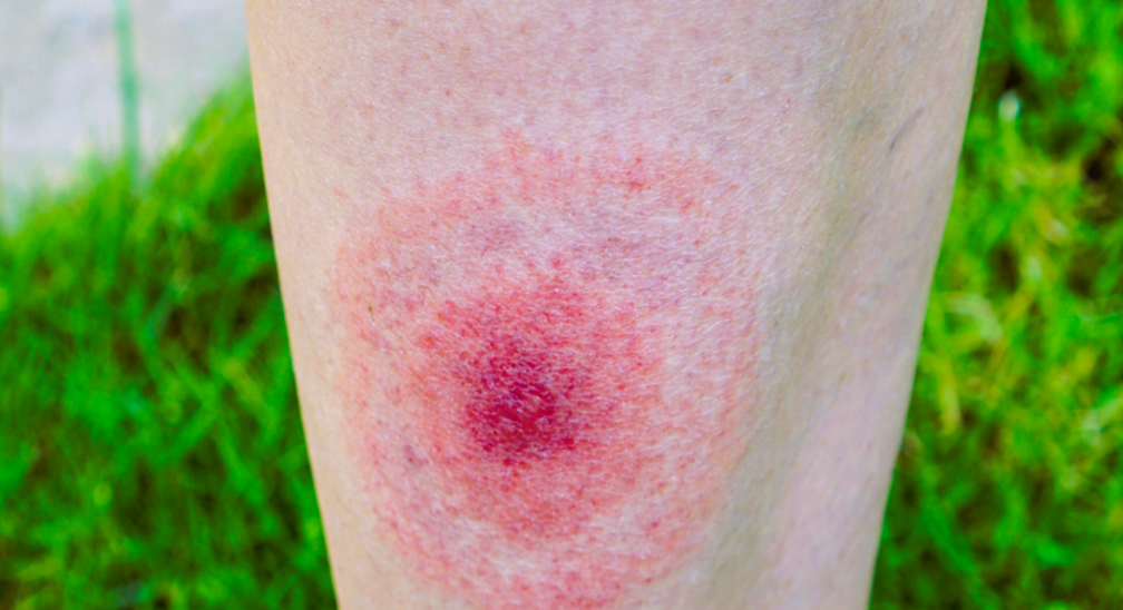 ticks while hiking